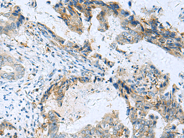 Immunohistochemistry of paraffin-embedded Human cervical cancer tissue using RMDN2 Polyclonal Antibody at dilution of 1:70(×200)