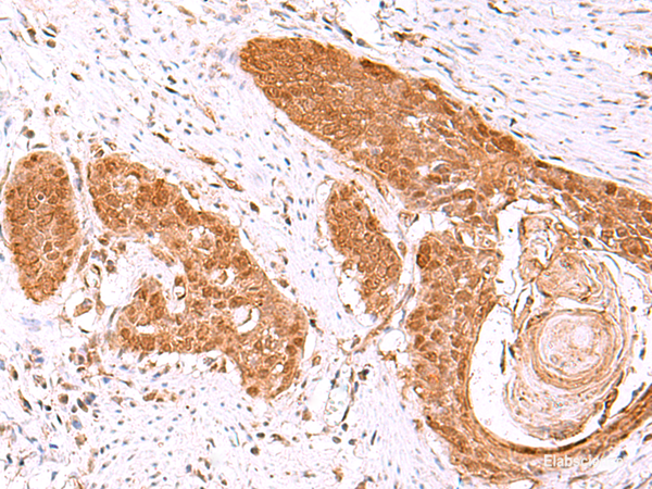 Immunohistochemistry of paraffin-embedded Human esophagus cancer tissue using FDPS Polyclonal Antibody at dilution of 1:60(×200)