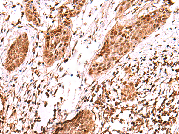 Immunohistochemistry of paraffin-embedded Human esophagus cancer tissue using AK9 Polyclonal Antibody at dilution of 1:60(×200)