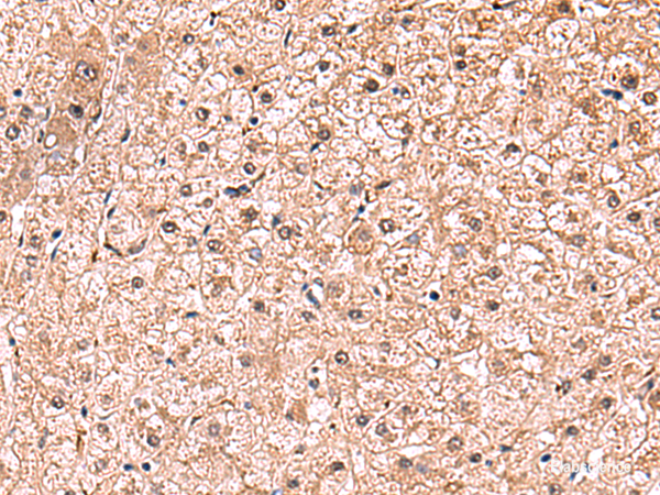 Immunohistochemistry of paraffin-embedded Human liver cancer tissue using RUSC1 Polyclonal Antibody at dilution of 1:90(×200)