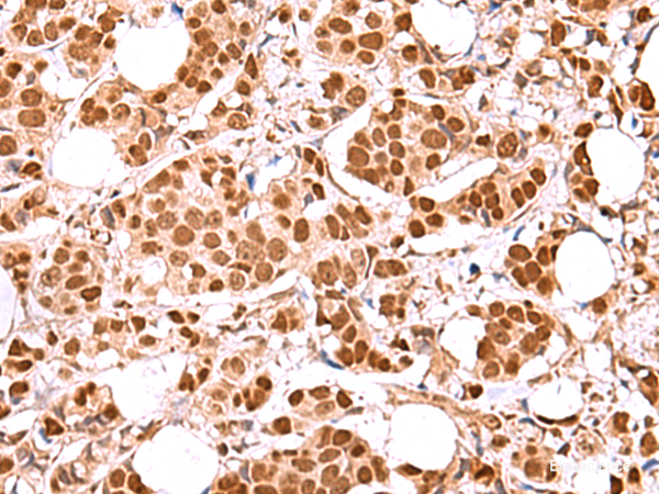 Immunohistochemistry of paraffin-embedded Human breast cancer tissue using RCOR3 Polyclonal Antibody at dilution of 1:60(×200)
