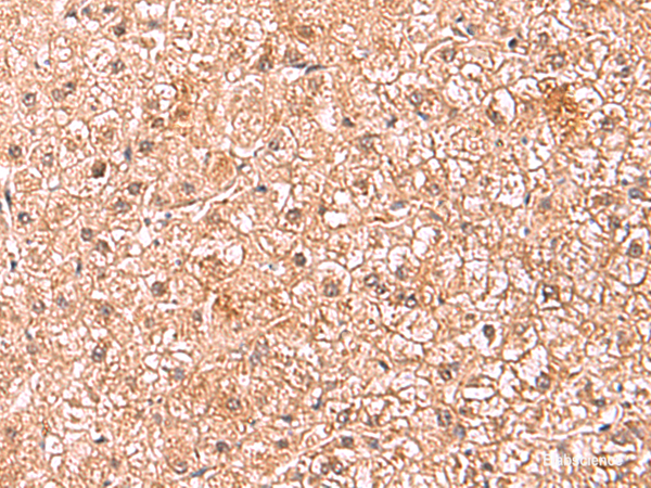 Immunohistochemistry of paraffin-embedded Human liver cancer tissue using ASTN2 Polyclonal Antibody at dilution of 1:80(×200)