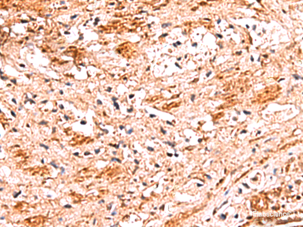 Immunohistochemistry of paraffin-embedded Human liver cancer tissue using NADK Polyclonal Antibody at dilution of 1:70(×200)