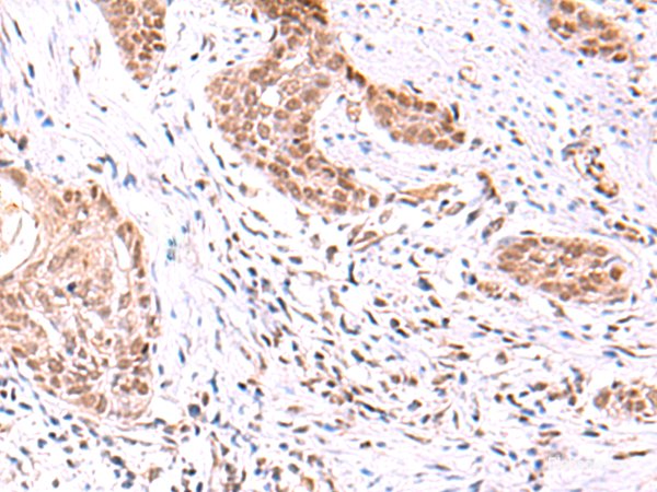 Immunohistochemistry of paraffin-embedded Human esophagus cancer tissue using TRMT12 Polyclonal Antibody at dilution of 1:80(×200)