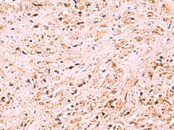 Immunohistochemistry of paraffin-embedded Human prost at e cancer tissue using ZSWIM1 Polyclonal Antibody at dilution of 1:95(×200)