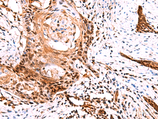 Immunohistochemistry of paraffin-embedded Human esophagus cancer tissue using TSEN2 Polyclonal Antibody at dilution of 1:60(×200)