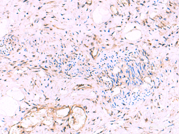 Immunohistochemistry of paraffin-embedded Human cervical cancer tissue using KATNAL1 Polyclonal Antibody at dilution of 1:95(×200)