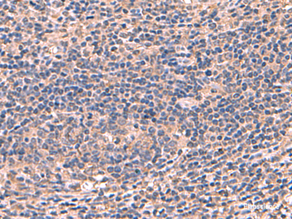 Immunohistochemistry of paraffin-embedded Human cervical cancer tissue using AHCYL1 Polyclonal Antibody at dilution of 1:70(×200)