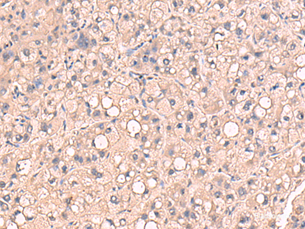 Immunohistochemistry of paraffin-embedded Human liver cancer tissue using RIOK1 Polyclonal Antibody at dilution of 1:80(×200)