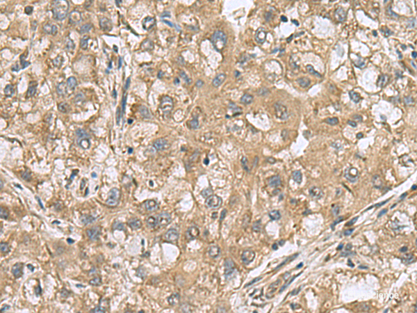 Immunohistochemistry of paraffin-embedded Human liver cancer tissue using PAPSS2 Polyclonal Antibody at dilution of 1:60(×200)
