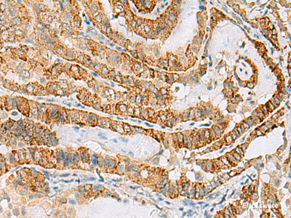 Immunohistochemistry of paraffin-embedded Human thyroid cancer tissue using FARP2 Polyclonal Antibody at dilution of 1:70(×200)