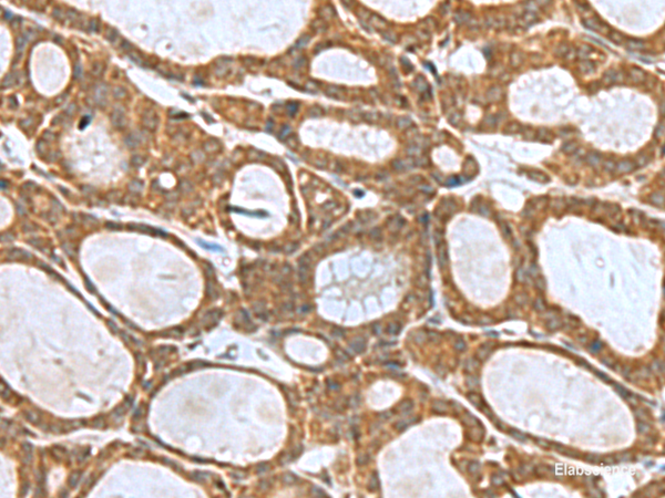Immunohistochemistry of paraffin-embedded Human thyroid cancer tissue using KIF2A Polyclonal Antibody at dilution of 1:55(×200)
