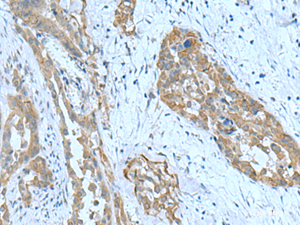 Immunohistochemistry of paraffin-embedded Human thyroid cancer tissue using SRPK2 Polyclonal Antibody at dilution of 1:90(×200)