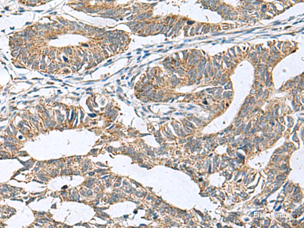 Immunohistochemistry of paraffin-embedded Human colorectal cancer tissue using DPY19L3 Polyclonal Antibody at dilution of 1:120(×200)