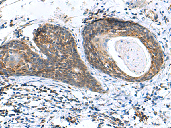 Immunohistochemistry of paraffin-embedded Human esophagus cancer tissue using AP1S3 Polyclonal Antibody at dilution of 1:70(×200)