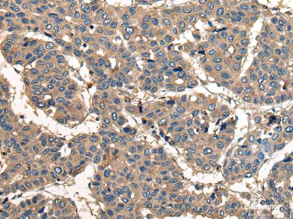 Immunohistochemistry of paraffin-embedded Human liver cancer tissue using CORO1B Polyclonal Antibody at dilution of 1:40(×200)
