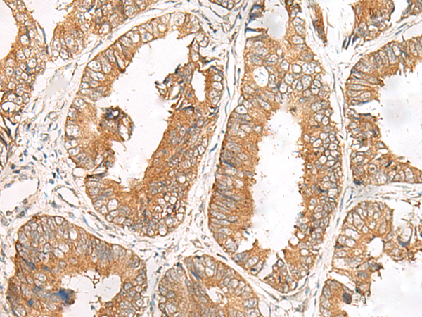 Immunohistochemistry of paraffin-embedded Human colorectal cancer tissue using FERD3L Polyclonal Antibody at dilution of 1:85(×200)