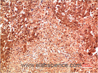 Immunohistochemistry of paraffin-embedded Human lung carcinoma tissue using P38 Monoclonal Antibody at dilution of 1:200.