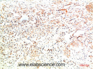 Immunohistochemistry of paraffin-embedded Human lung carcinoma tissue using COL2A1 Monoclonal Antibody at dilution of 1:200.
