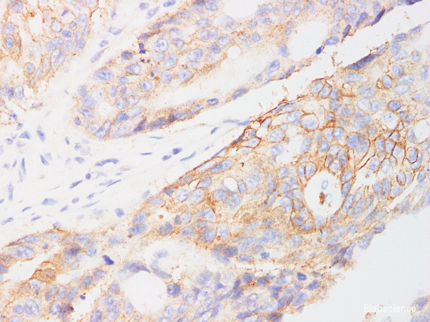 Immunohistochemistry of paraffin-embedded Human colon cancer using EpCAM Polyclonl Antibody at dilution of 1:200.