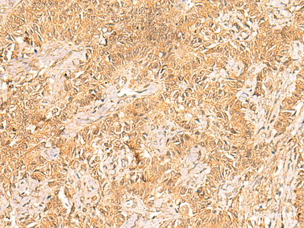 Immunohistochemistry of paraffin-embedded Human ovarian cancer tissue using TRMT112 Polyclonal Antibody at dilution of 1:30(×200)