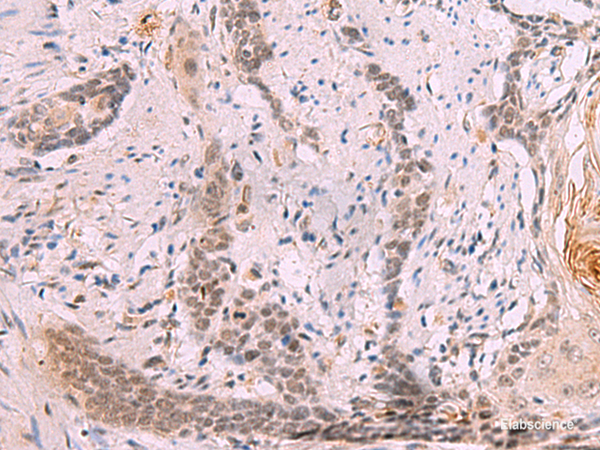 Immunohistochemistry of paraffin-embedded Human esophagus cancer tissue using INO80 Polyclonal Antibody at dilution of 1:70(×200)