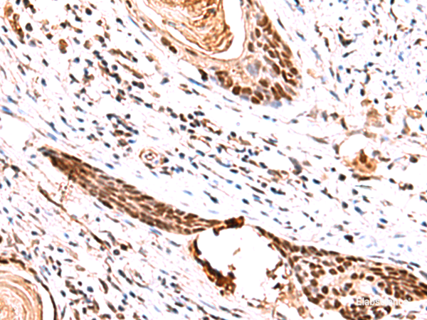 Immunohistochemistry of paraffin-embedded Human esophagus cancer tissue using IRF2BP1 Polyclonal Antibody at dilution of 1:30(×200)