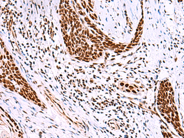 Immunohistochemistry of paraffin-embedded Human esophagus cancer tissue using ISY1-RAB43 Polyclonal Antibody at dilution of 1:30(×200)