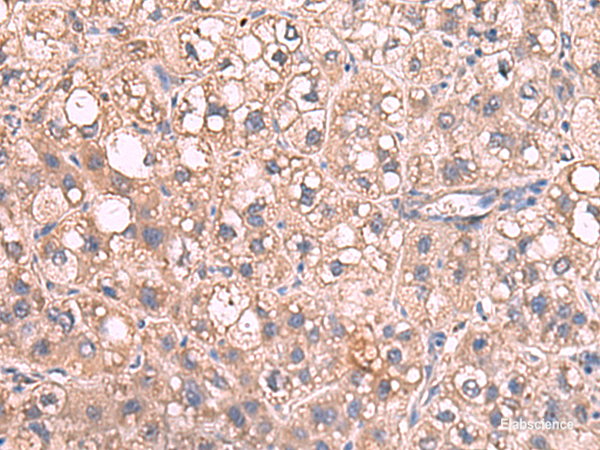 Immunohistochemistry of paraffin-embedded Human liver cancer tissue using JAZF1 Polyclonal Antibody at dilution of 1:55(×200)