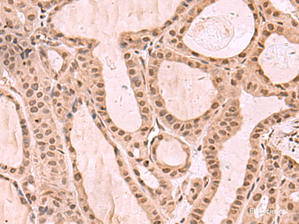 Immunohistochemistry of paraffin-embedded Human thyroid cancer tissue using KDM7A Polyclonal Antibody at dilution of 1:35(×200)