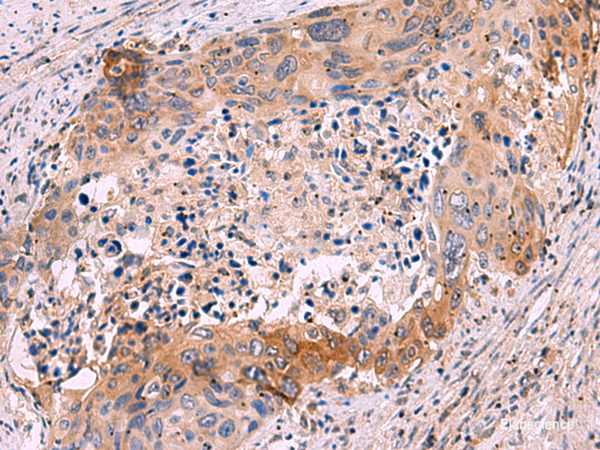 Immunohistochemistry of paraffin-embedded Human cervical cancer tissue using GRIK4 Polyclonal Antibody at dilution of 1:50(×200)