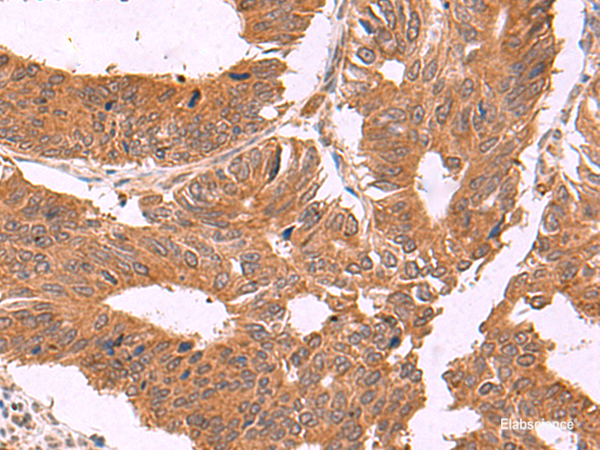 Immunohistochemistry of paraffin-embedded Human colorectal cancer tissue using ZBTB33 Polyclonal Antibody at dilution of 1:30(×200)