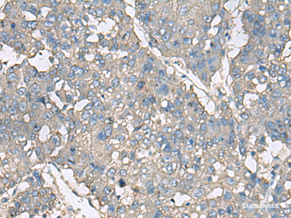 Immunohistochemistry of paraffin-embedded Human liver cancer tissue using TNF Polyclonal Antibody at dilution of 1:40(×200)