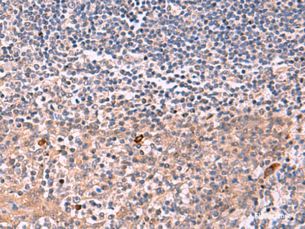 Immunohistochemistry of paraffin-embedded Human tonsil tissue using IFNA1:IFNA13 Polyclonal Antibody at dilution of 1:35(×200)
