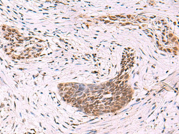 Immunohistochemistry of paraffin-embedded Human esophagus cancer tissue using CREBBP Polyclonal Antibody at dilution of 1:35(×200)