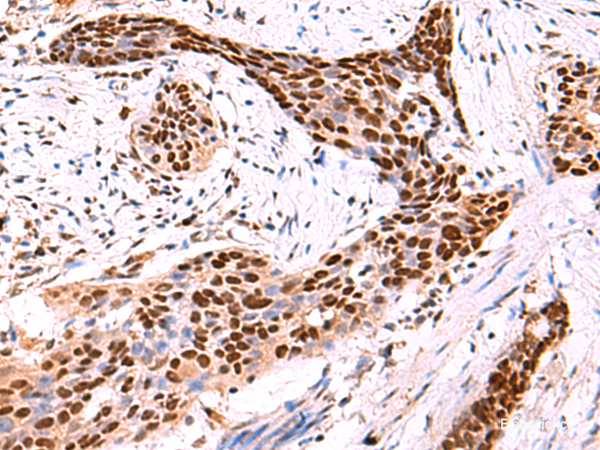 Immunohistochemistry of paraffin-embedded Human esophagus cancer tissue using SOX2 Polyclonal Antibody at dilution of 1:50(×200)