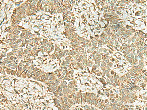 Immunohistochemistry of paraffin-embedded Human ovarian cancer tissue using KAT7 Polyclonal Antibody at dilution of 1:45(×200)