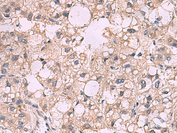 Immunohistochemistry of paraffin-embedded Human liver cancer tissue using KCNIP1 Polyclonal Antibody at dilution of 1:40(×200)