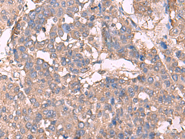 Immunohistochemistry of paraffin-embedded Human liver cancer tissue using KCNN2 Polyclonal Antibody at dilution of 1:30(×200)