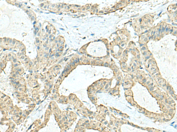 Immunohistochemistry of paraffin-embedded Human thyroid cancer tissue using CD9 Polyclonal Antibody at dilution of 1:40(×200)