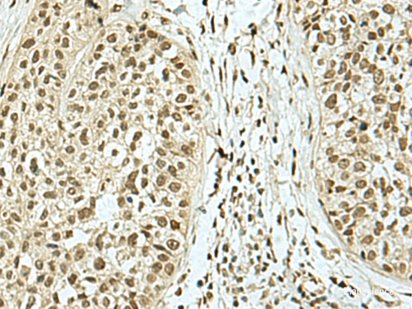 Immunohistochemistry of paraffin-embedded Human esophagus cancer tissue using KHSRP Polyclonal Antibody at dilution of 1:40(×200)