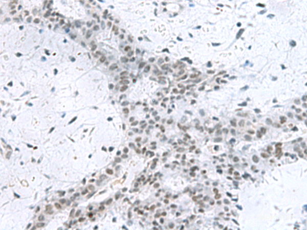 Immunohistochemistry of paraffin-embedded Human breast cancer tissue using PCLAF Polyclonal Antibody at dilution of 1:80(×200)