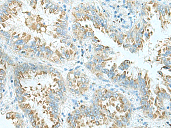 Immunohistochemistry of paraffin-embedded Human lung cancer tissue using SHTN1 Polyclonal Antibody at dilution of 1:30(×200)