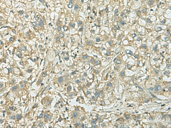 Immunohistochemistry of paraffin-embedded Human liver cancer tissue using KIF21B Polyclonal Antibody at dilution of 1:40(×200)