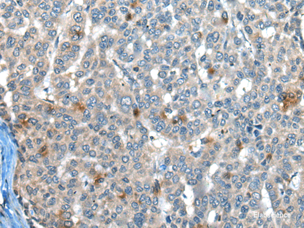 Immunohistochemistry of paraffin-embedded Human liver cancer tissue using CAPN3 Polyclonal Antibody at dilution of 1:30(×200)