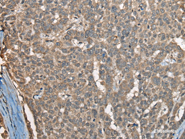 Immunohistochemistry of paraffin-embedded Human liver cancer tissue using COX7A2L Polyclonal Antibody at dilution of 1:30(×200)