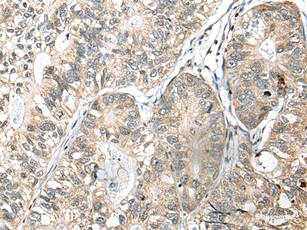 Immunohistochemistry of paraffin-embedded Human gastric cancer tissue using SLAMF7 Polyclonal Antibody at dilution of 1:30(×200)