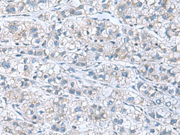 Immunohistochemistry of paraffin-embedded Human liver cancer tissue using GDF9 Polyclonal Antibody at dilution of 1:55(×200)