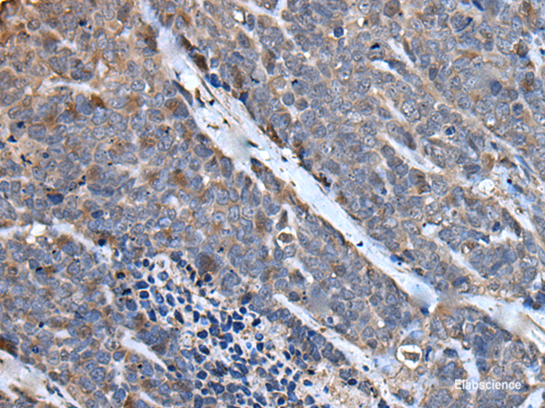 Immunohistochemistry of paraffin-embedded Human thyroid cancer tissue using MCM10 Polyclonal Antibody at dilution of 1:50(×200)
