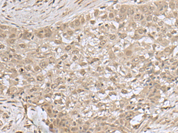 Immunohistochemistry of paraffin-embedded Human esophagus cancer tissue using NEUROG3 Polyclonal Antibody at dilution of 1:55(×200)